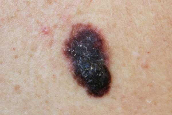 Types of Skin Cancer Mole Patrol Bulk Bill Skin Check