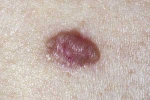 Types of Skin Cancer - Mole Patrol | Bulk Bill Skin Check Perth